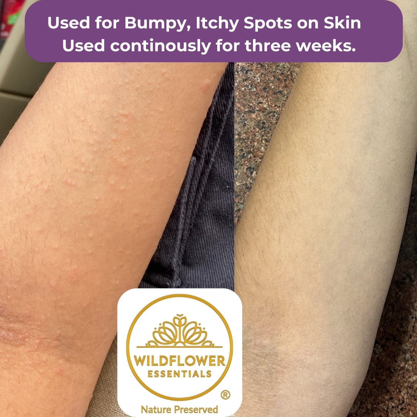 Soothing Oil for Eczema, Psoriasis & Dermatitis | 50ml Wildflower Essentials