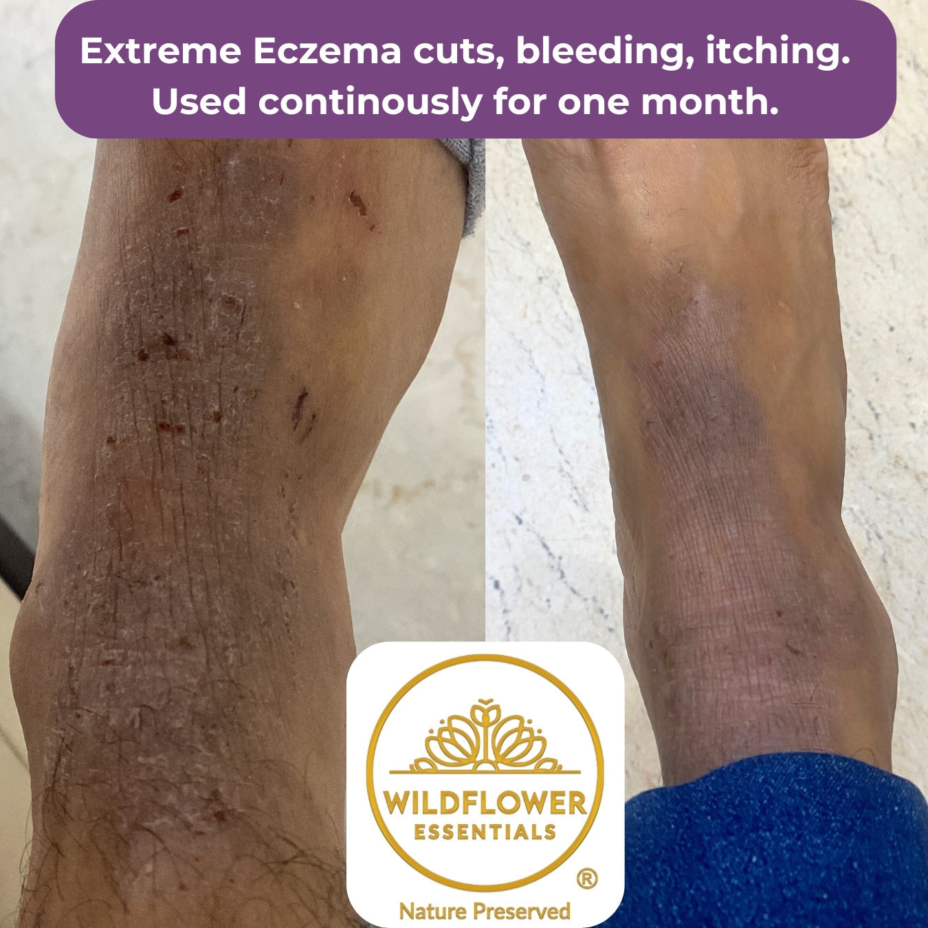 Soothing Oil for Eczema, Psoriasis & Dermatitis | 50ml Wildflower Essentials