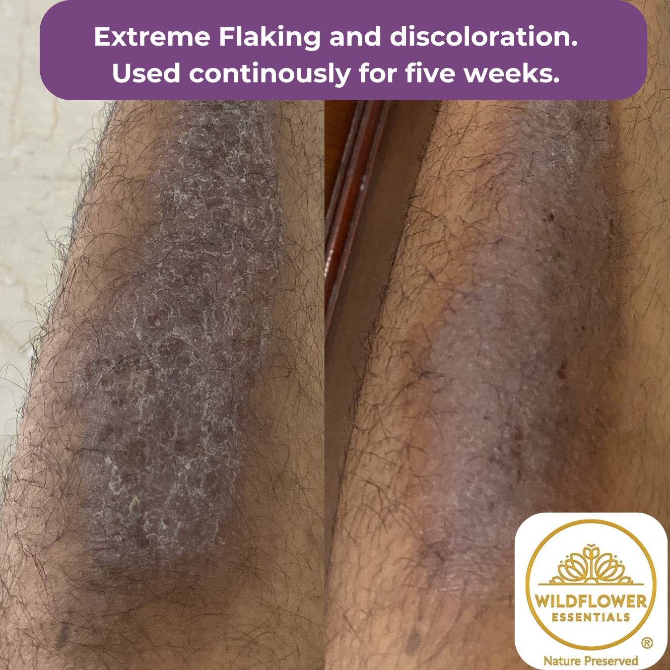 Soothing Oil for Eczema, Psoriasis & Dermatitis | 50ml Wildflower Essentials