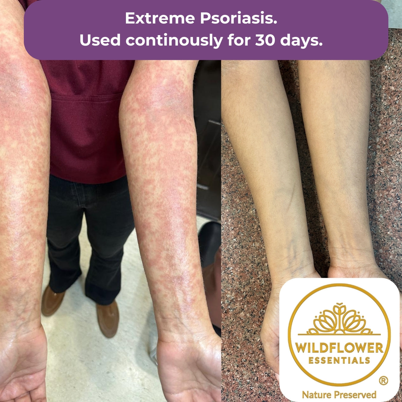 Soothing Oil for Eczema, Psoriasis & Dermatitis | 50ml Wildflower Essentials