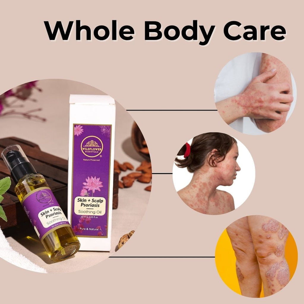 Soothing Oil for Eczema, Psoriasis & Dermatitis | 50ml Wildflower Essentials