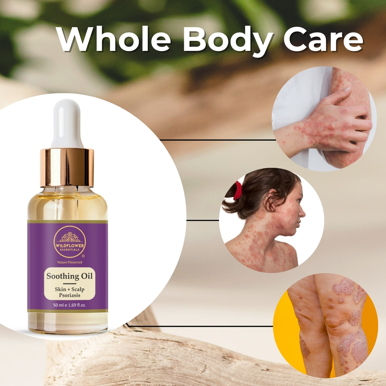 Soothing Oil for Eczema, Psoriasis & Dermatitis | 50ml