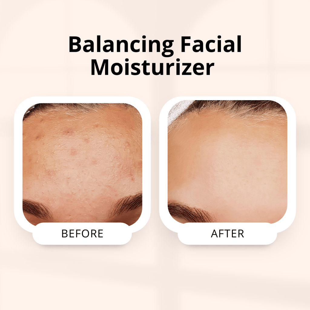 Balancing Facial Moisturising Gel - Fights Acne and Breakouts | 50g
