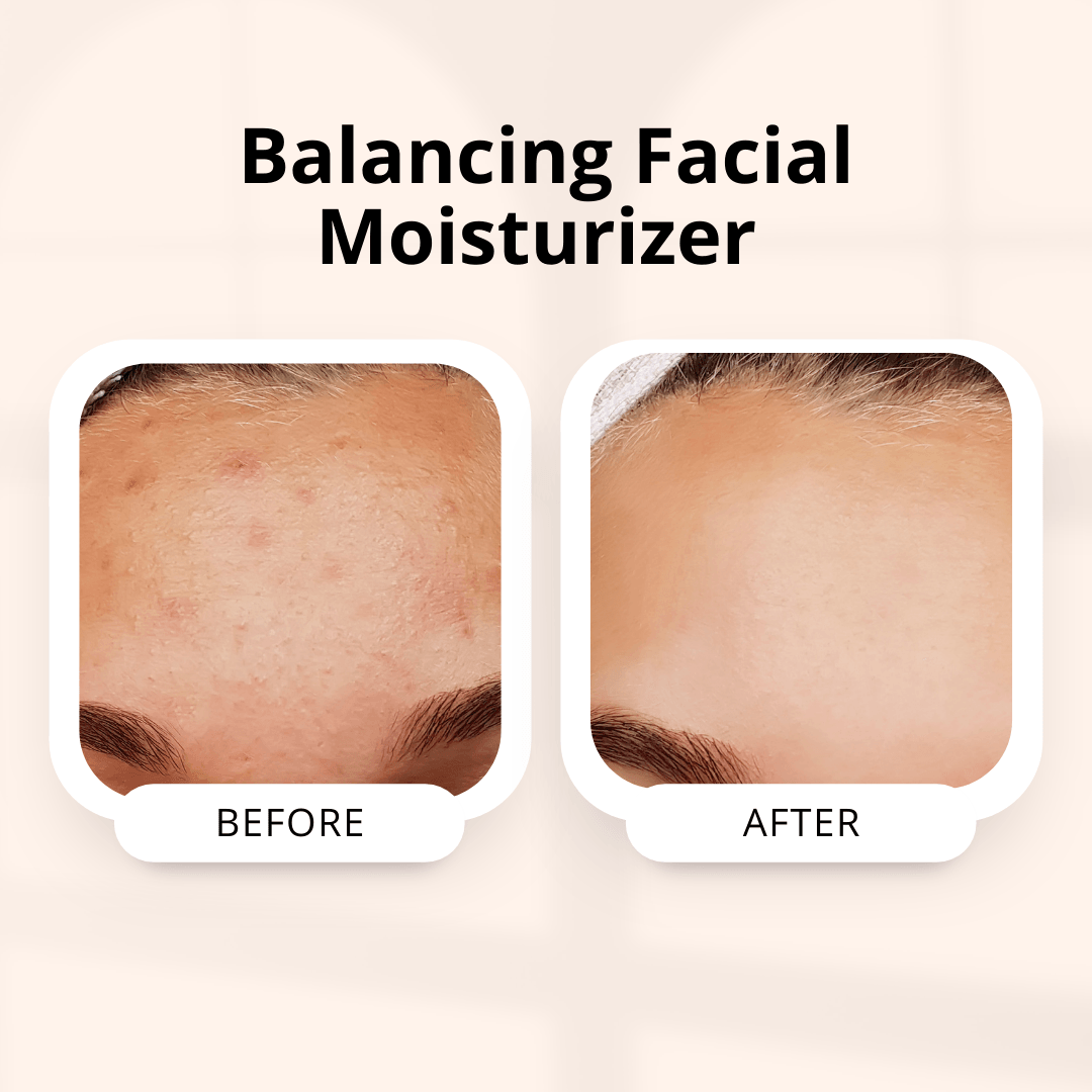 Balancing Facial Moisturising Gel - Fights Acne and Breakouts | 50g